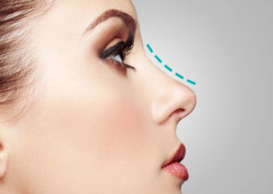 RINOPLASTIA-TJ-PLAST
