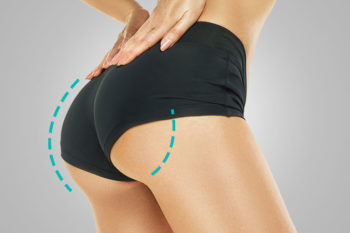 lipoinyeccion-en-gluteos-tj-plast